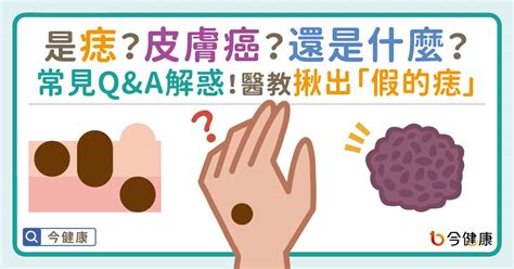 右下巴痣長毛|是痣？皮膚癌？還是什麼？常見Q&A解惑！醫教揪出「。